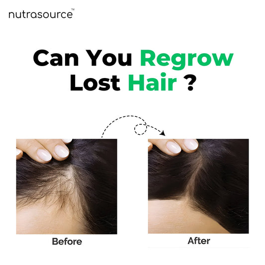 Can You Regrow Lost Hair?